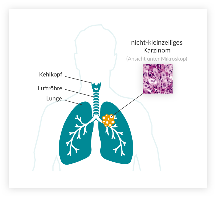 Nicht-kleinzelliger Lungenkrebs