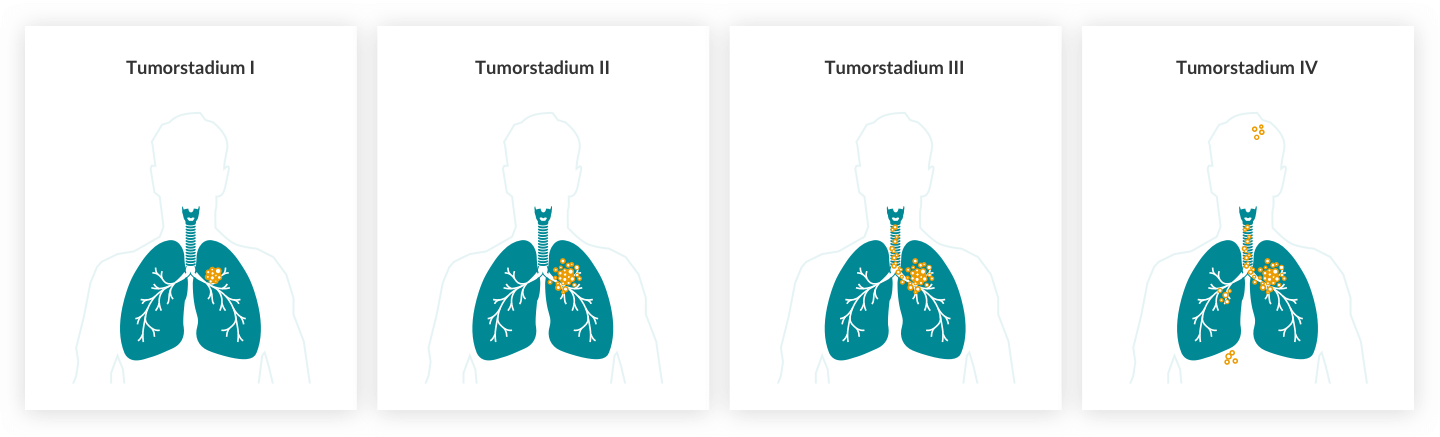 Lungenkrebs: Tumorstadien I-IV